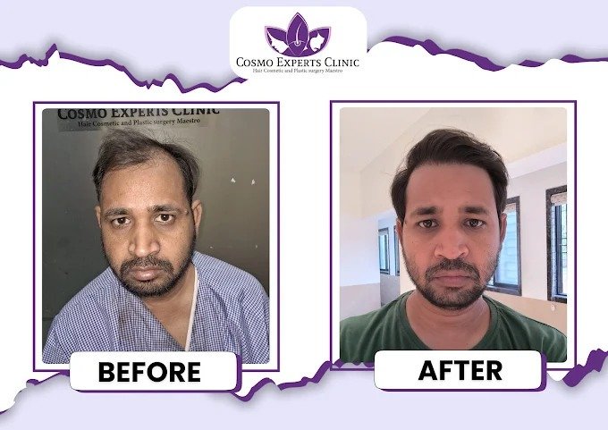 Crown Area Transformation Before